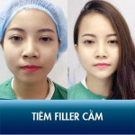 Tiêm Filler cằm không phẫu thuật Kangnam – 10 phút sở hữu cằm Vline thanh tú
