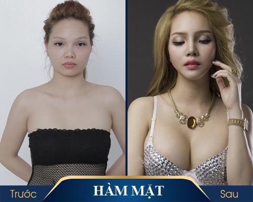 Gọt mặt V Line – Những màn “lột xác” ngoạn mục tại Kangnam gây CHẤN ĐỘNG