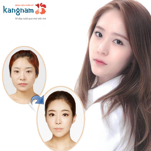 Top 2 cách làm mặt thon gọn hơn? Ưu và nhược điểm của từng cách làm thon mặt