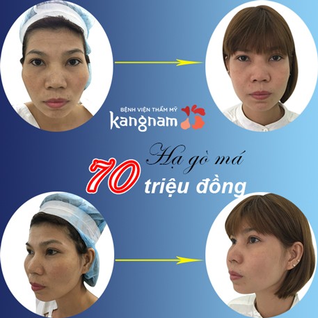 Chi phí nâng hạ gò má giá bao nhiêu tiền thì hợp lý? Bảng giá nâng hạ gò má.