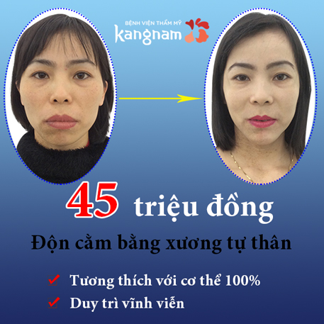 Chi phí độn cằm tự thân giá bao nhiêu tiền? Bảng giá độn cằm tự thân tại Kangnam.
