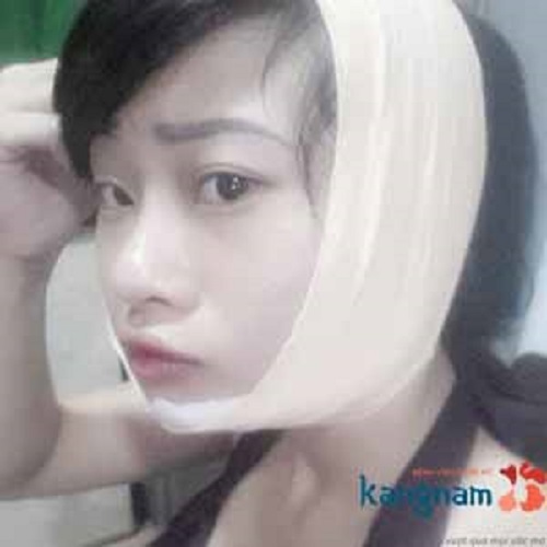Phản hồi: Phẫu thuật gọt mặt bao lâu hết sưng đau, lành và đẹp tự nhiên nhất?