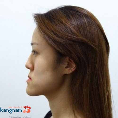 Khuôn mặt lưỡi cày là gì, có ảnh hưởng ra sao? Cách khắc phục mặt bị lưỡi cày