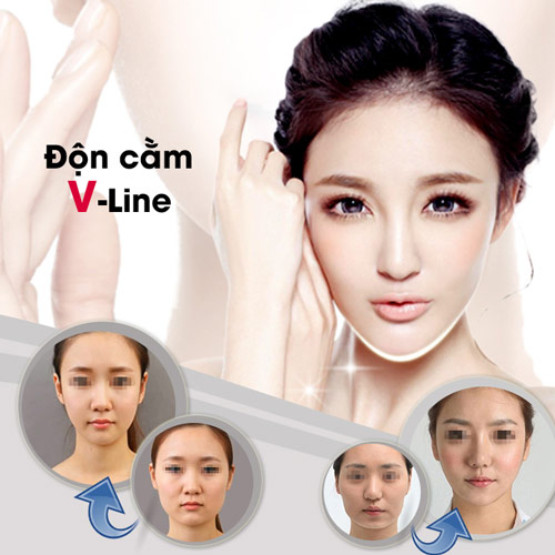 Độn cằm có ảnh hưởng gì không? Xét về thẩm mỹ, tướng số và sức khỏe lâu dài.