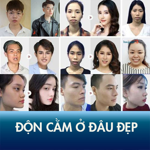 Review địa chỉ độn cằm ở đâu đẹp tự nhiên, an toàn, uy tín?