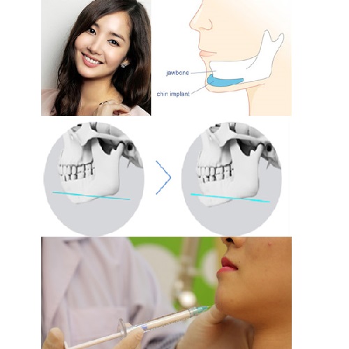 Độn cằm có biến chứng gì không, có hại gì không? 3 Lưu ý tránh “biến chứng”!!!