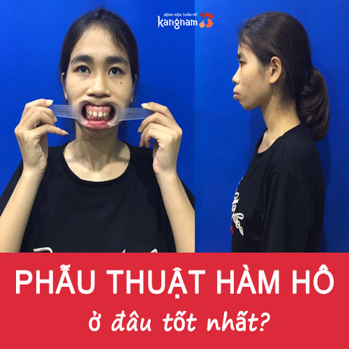 Phẫu thuật hàm hô ở đâu uy tín? Review địa phẫu thuật chỉnh hàm hô uy tín tại HN và TP.HCM