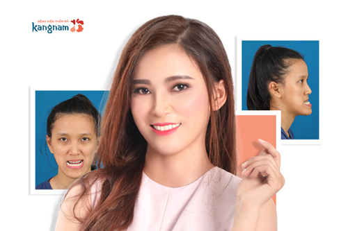 phẫu thuật mặt gãy lưỡi cày