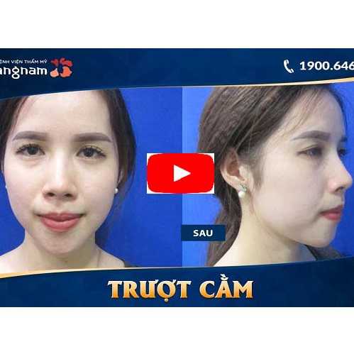 Video độn cằm V line của khách hàng ở Kangnam – Khắc phục cằm lẹm, ngắn, vểnh