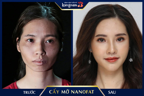sửa má hóp kangnam