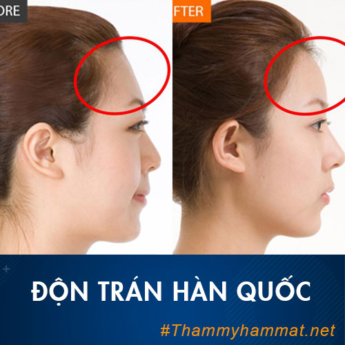 Độn trán giá bao nhiêu? Liệu làm đầy trán có nguy hiểm không? Nên làm ở đâu?
