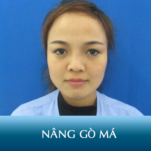 Nâng gò má Kangnam – Mặt cân đối, thanh tú chỉ sau 60 phút