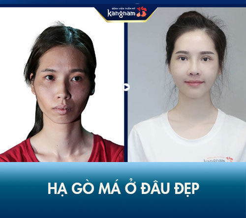 Hạ gò má ở đâu Đẹp, Tốt, Uy tín nhất tại Hà Nội, Tp Hcm