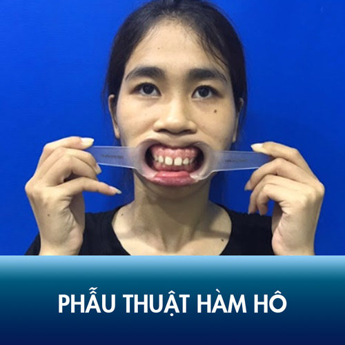 Phẫu thuật hàm hô không cần Niềng: An Toàn, Hồi phục nhanh