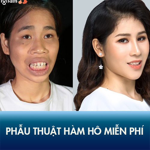 Kinh nghiệm phẫu thuật hàm hô miễn phí sau 30 ngày phục hồi của cô gái “khỉ đột”